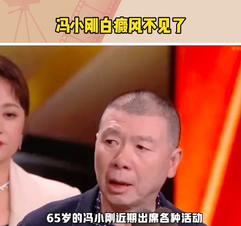 65岁冯小刚多年的白癜风“消失”了 自称不药而愈皮肤科专家回应
